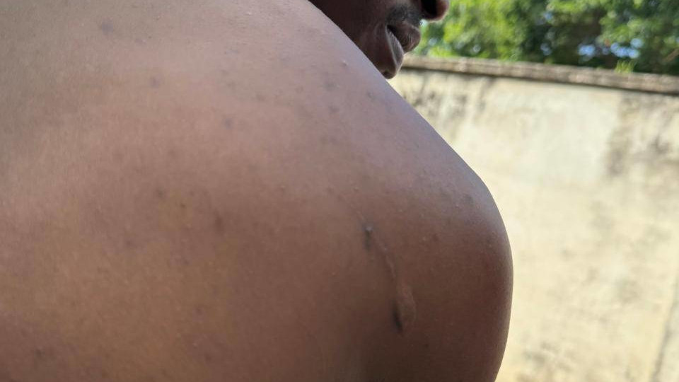 Matovu Shadrack, 24, a Ugandan man who was lured to work in a Cambodian scam compound shows a scar from violence he suffered, taken on April 6, 2026 in Phnom Penh. (Mech Dara/Mekong Independent/Creative Commons)